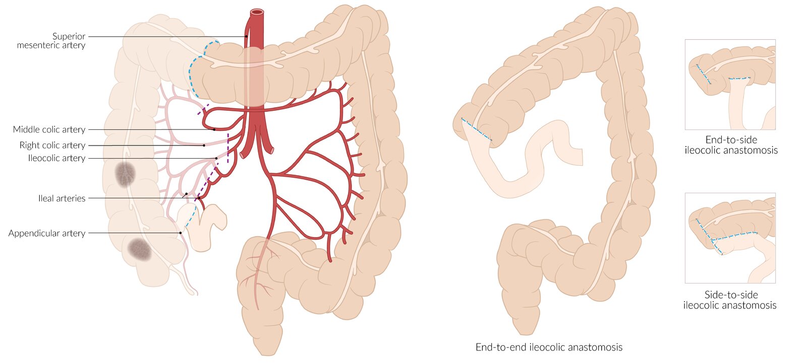 Right hemicolectomy