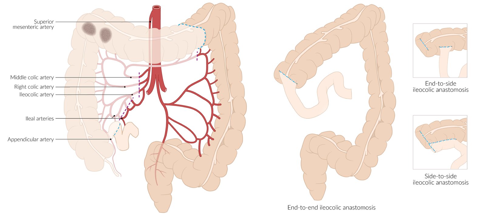 Extended right hemicolectomy