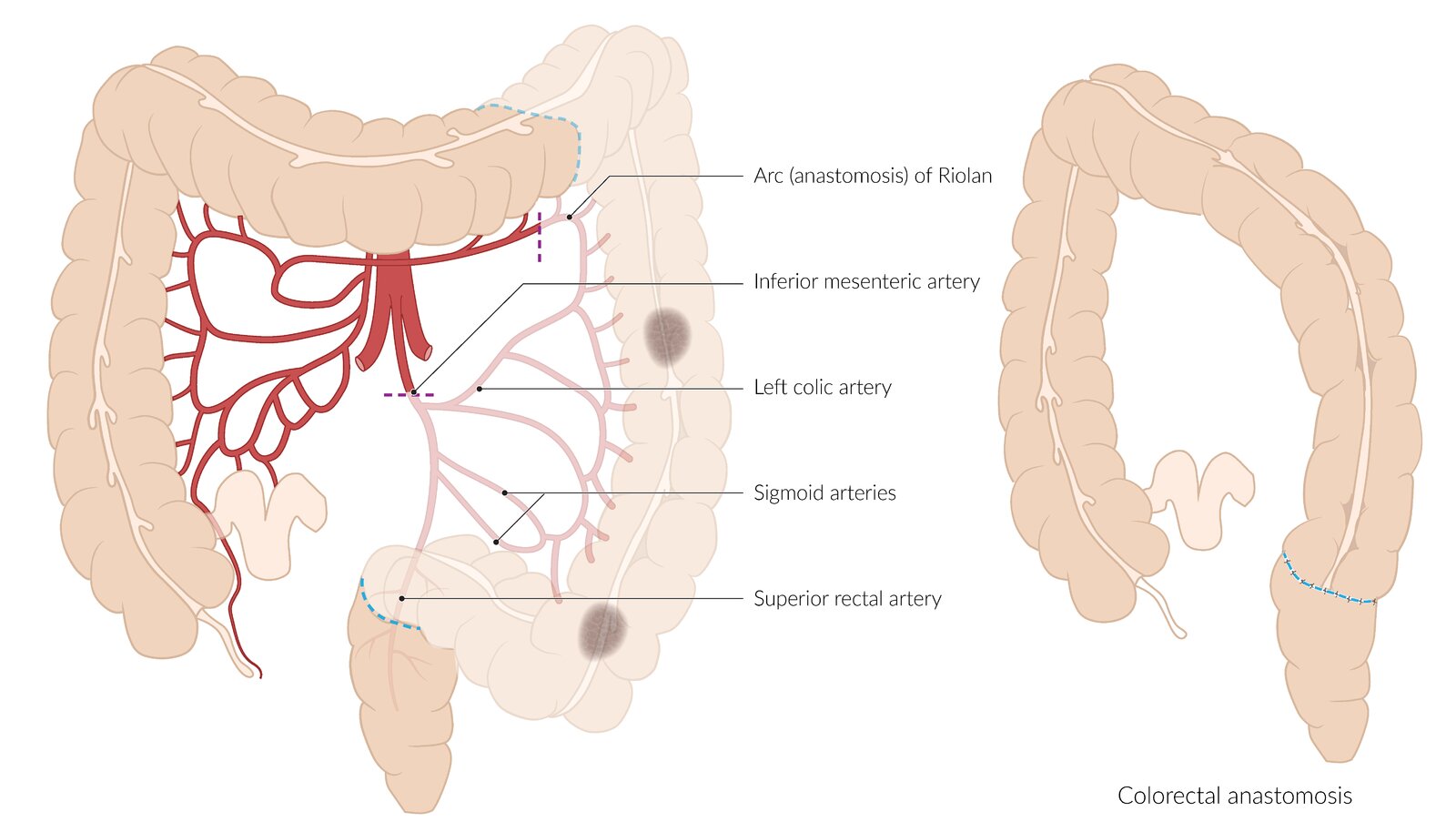 Left hemicolectomy