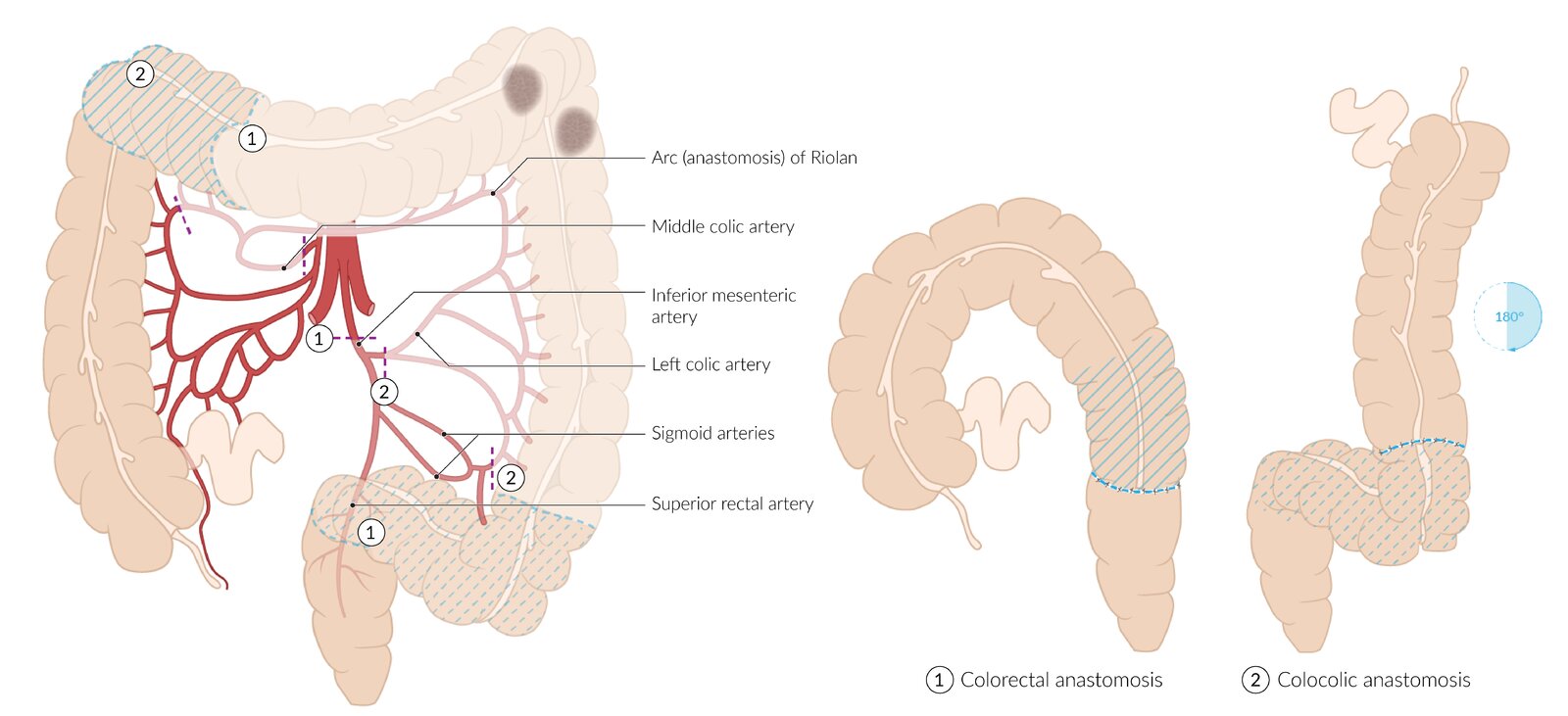 Extended left hemicolectomy