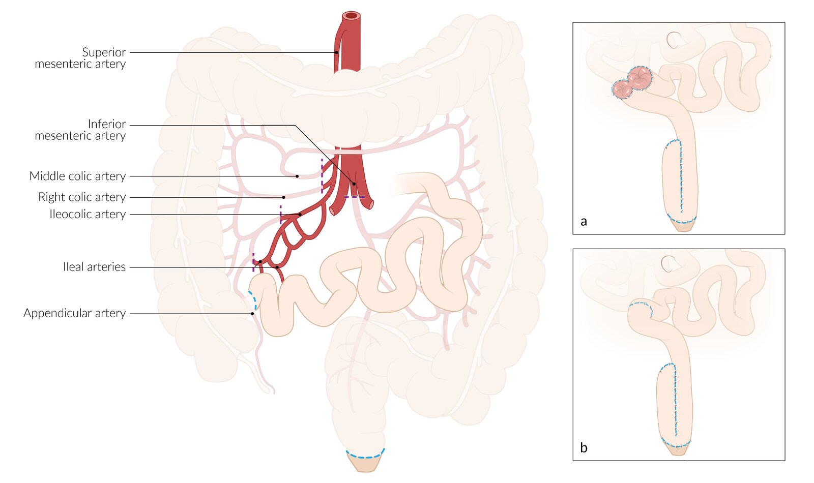 Restorative proctocolectomy