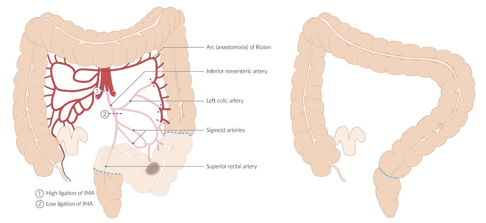 Radical sigmoid colectomy