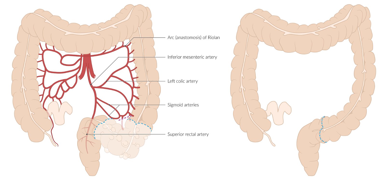 Sigmoid colectomy (in diverticulitis)