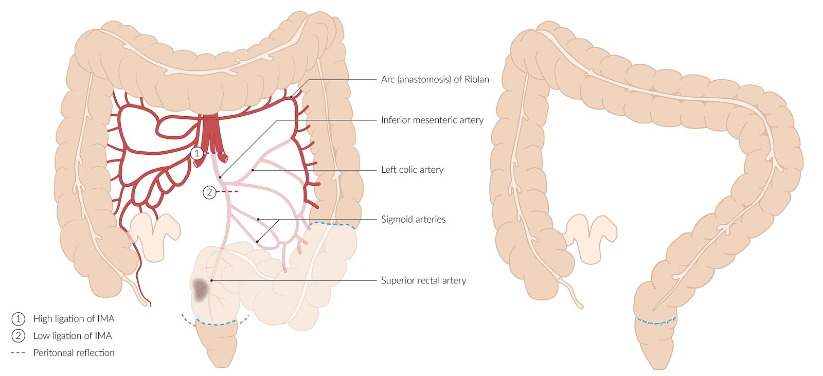 Anterior resection