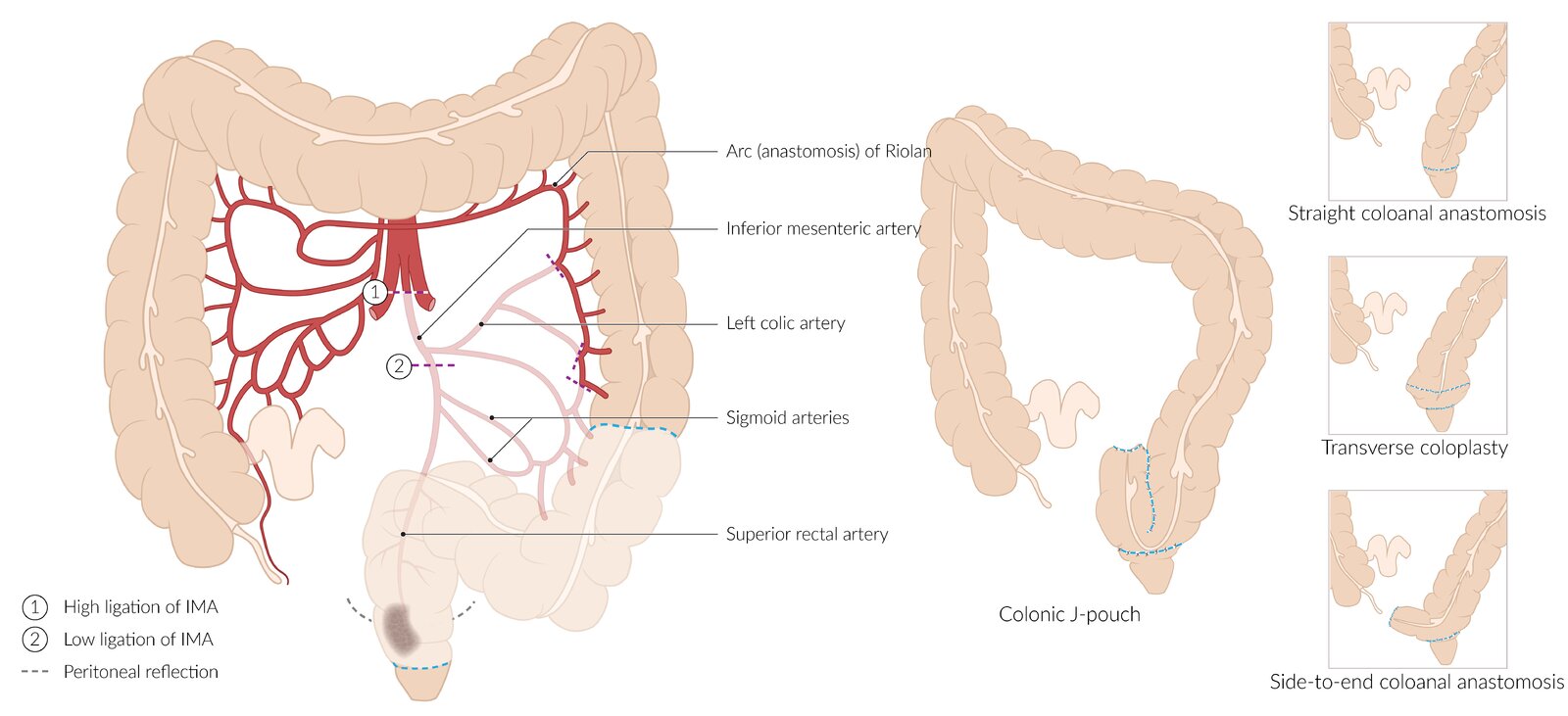 Low anterior resection