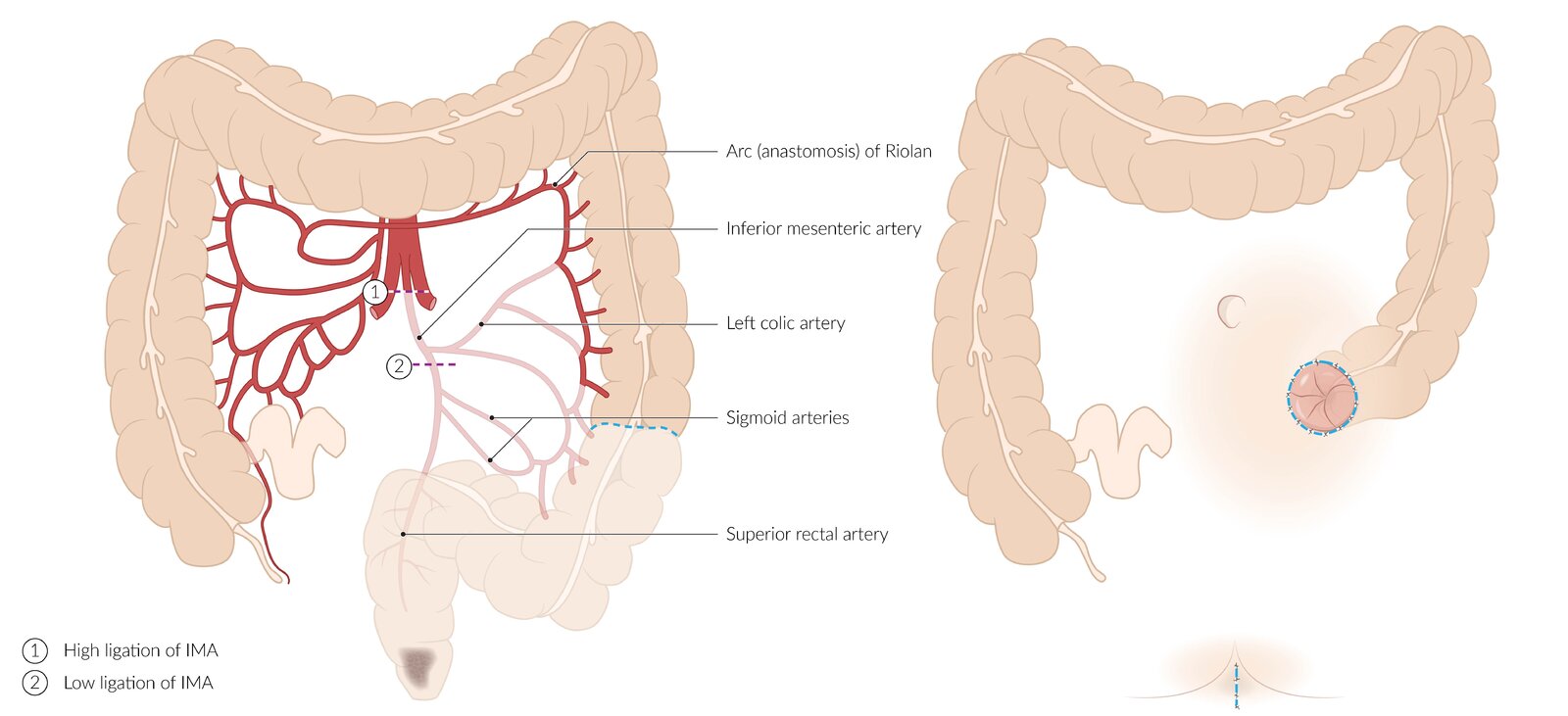 Abdominoperineal resection
