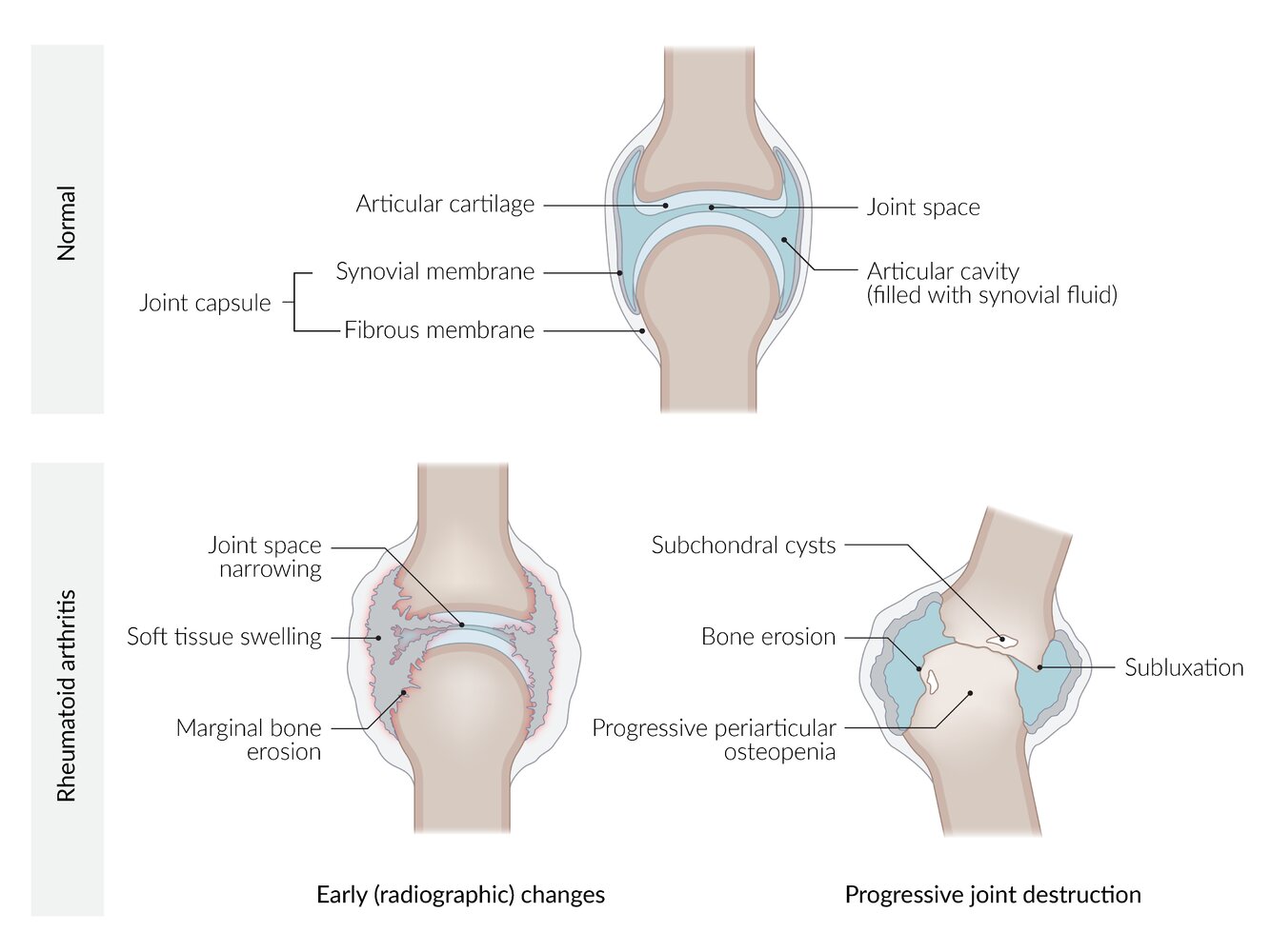 Schematic representation of the pathophysiology of rheumatoid arthritis