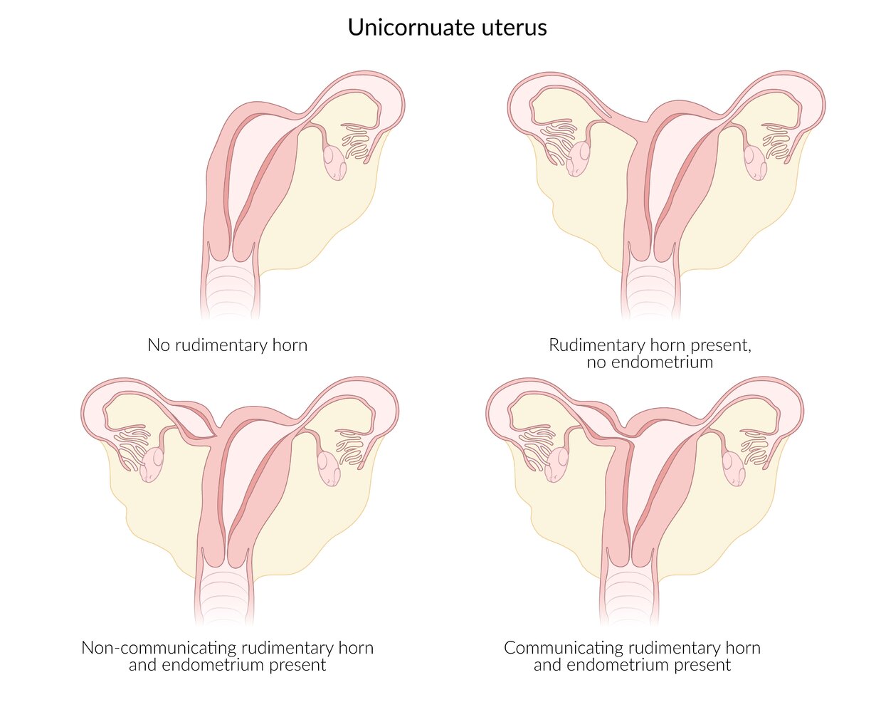 Anomalies of the uterus II