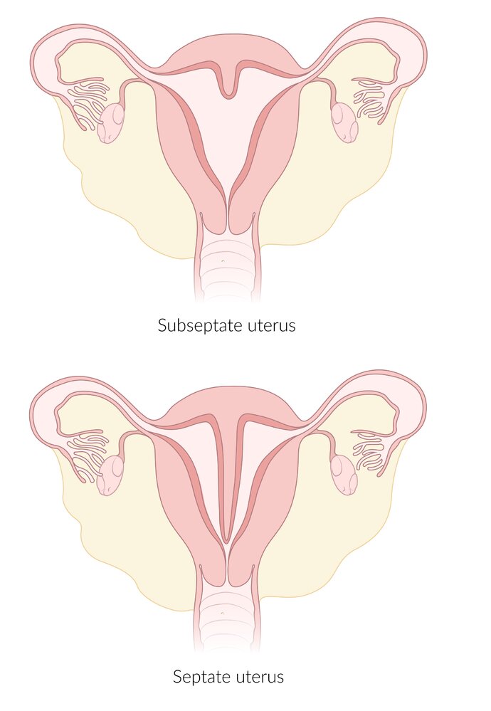 Anomalies of the uterus III
