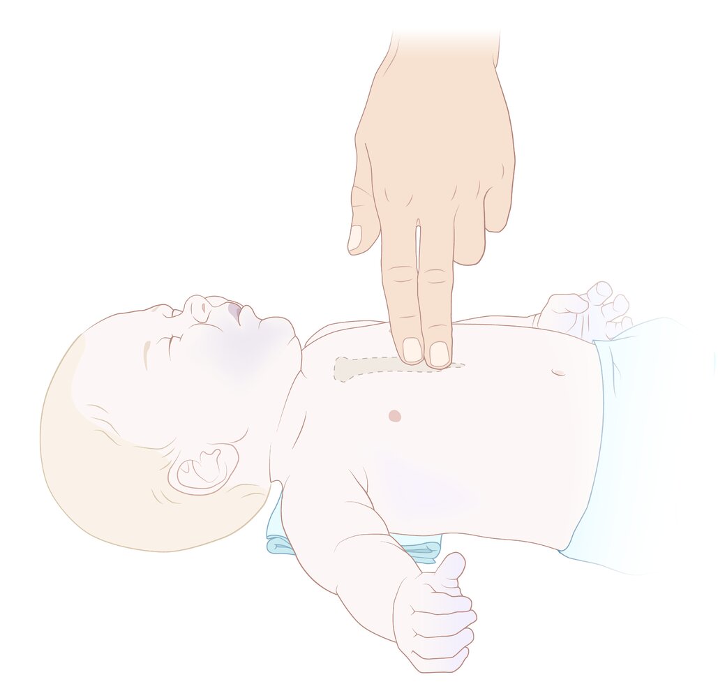 Two-finger technique for chest compressions in neonates and infants
