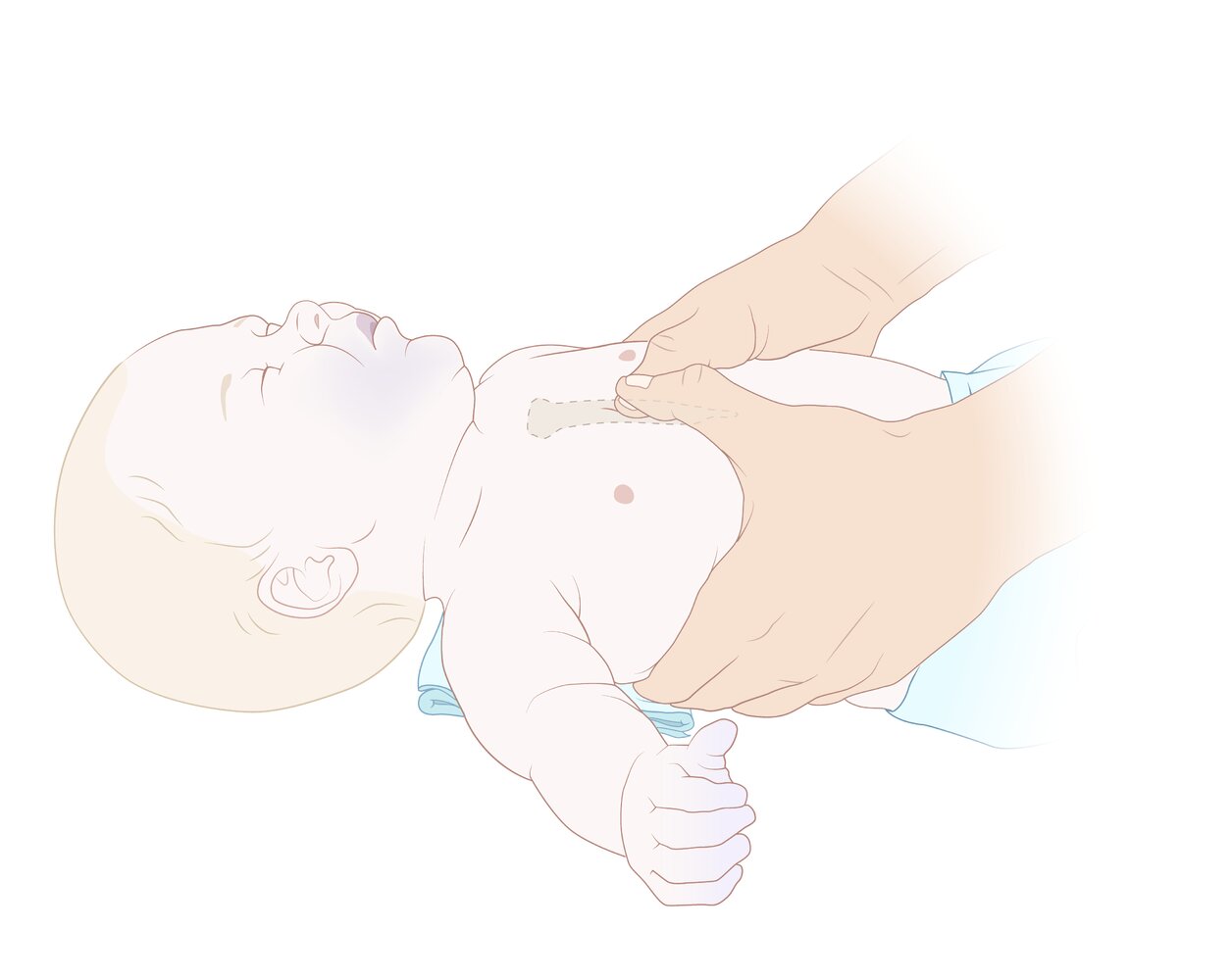 Two-thumb-encircling hands technique for chest compressions in neonates and infants