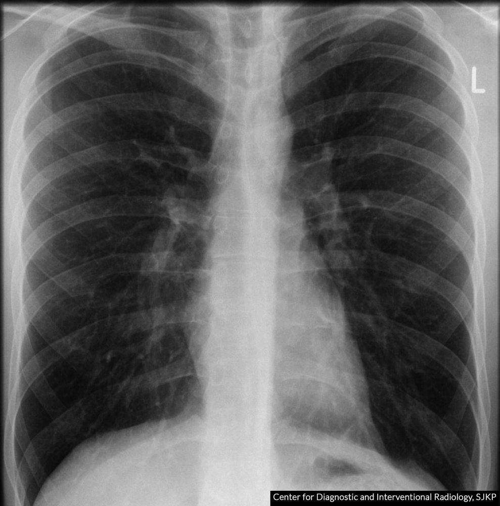Cardiothoracic ratio