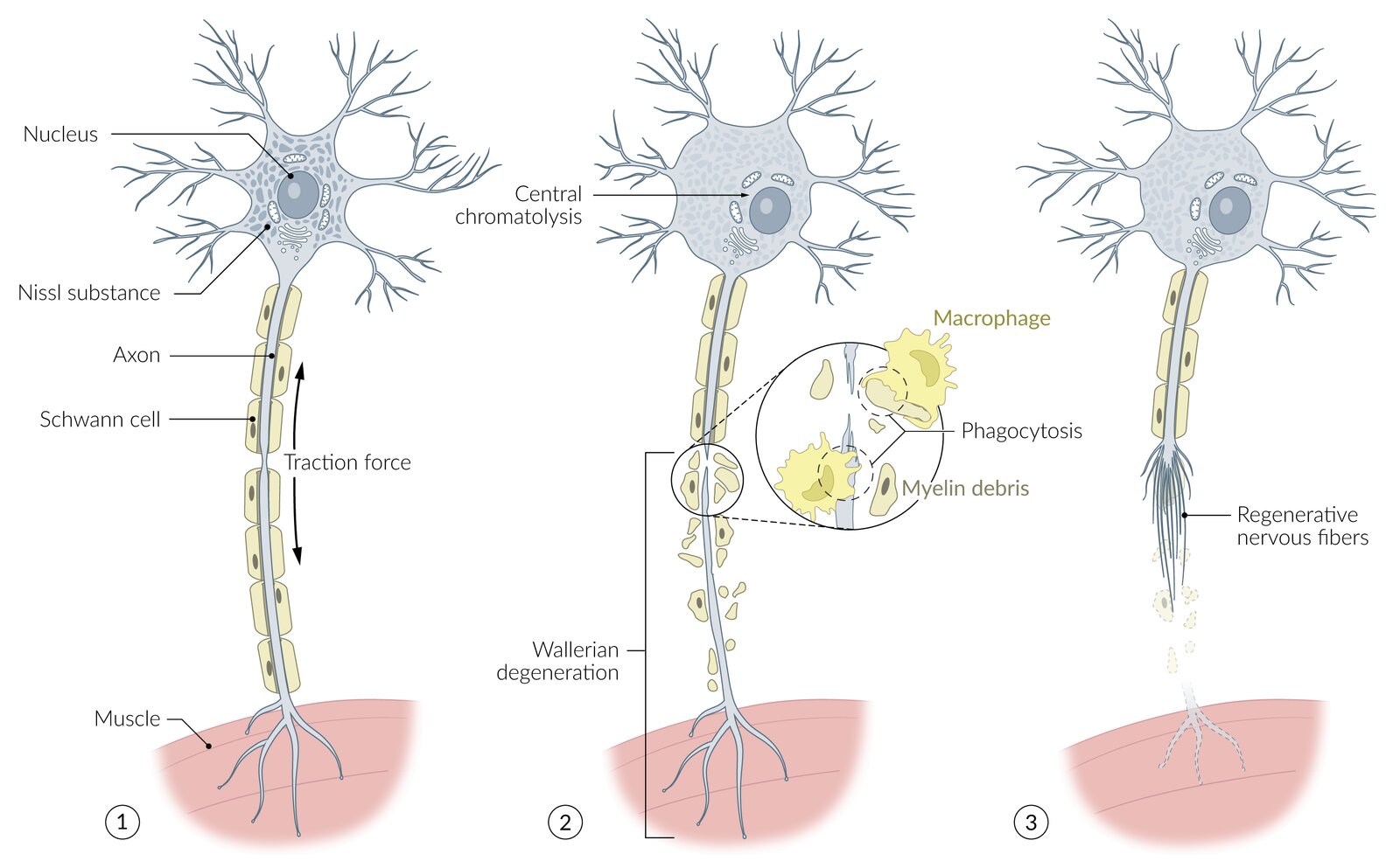 Axonotmesis