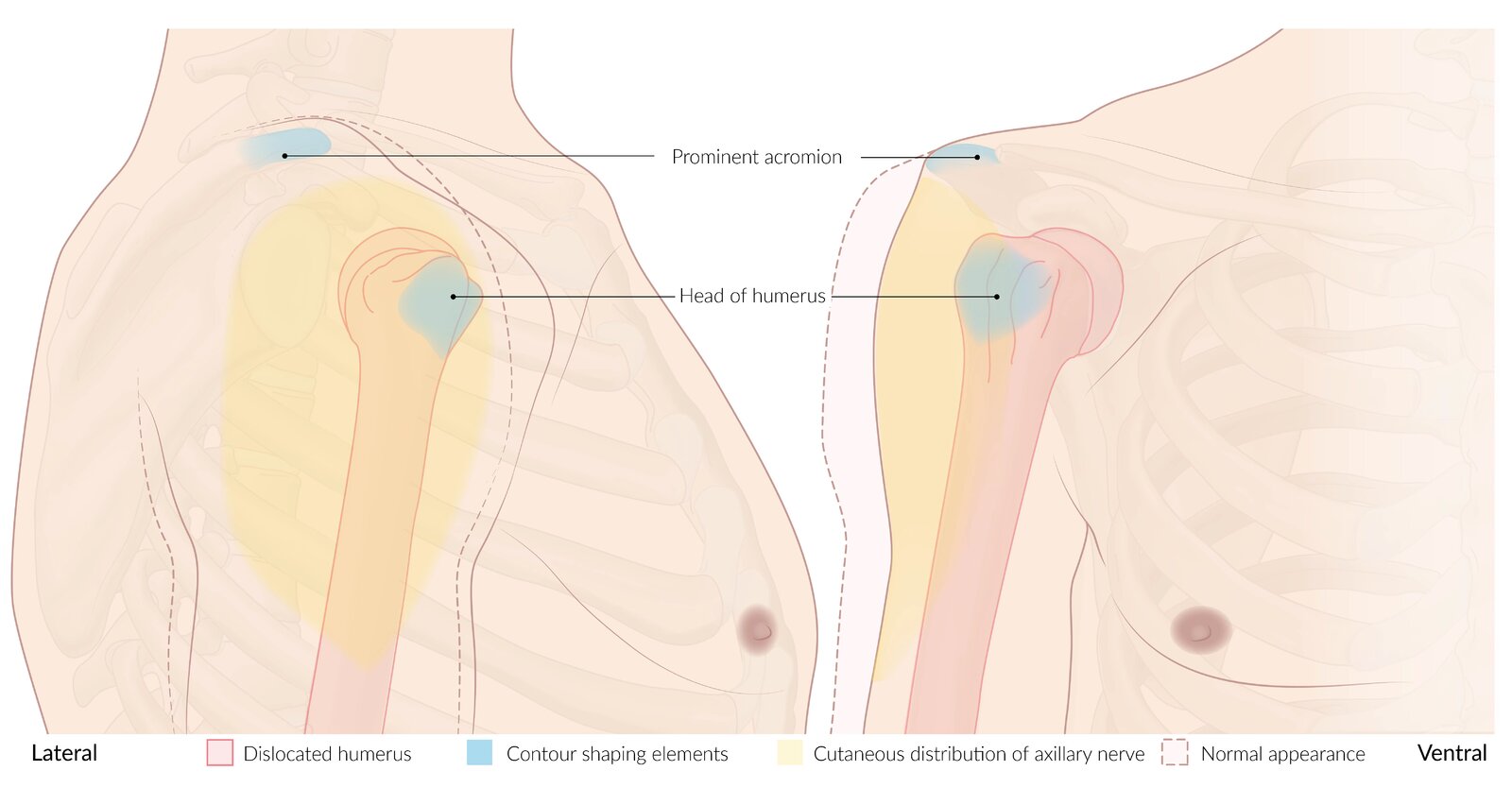 Anterior shoulder dislocation surface anatomy