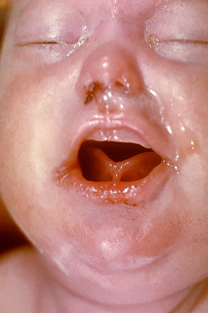 Newborn with congenital syphilis