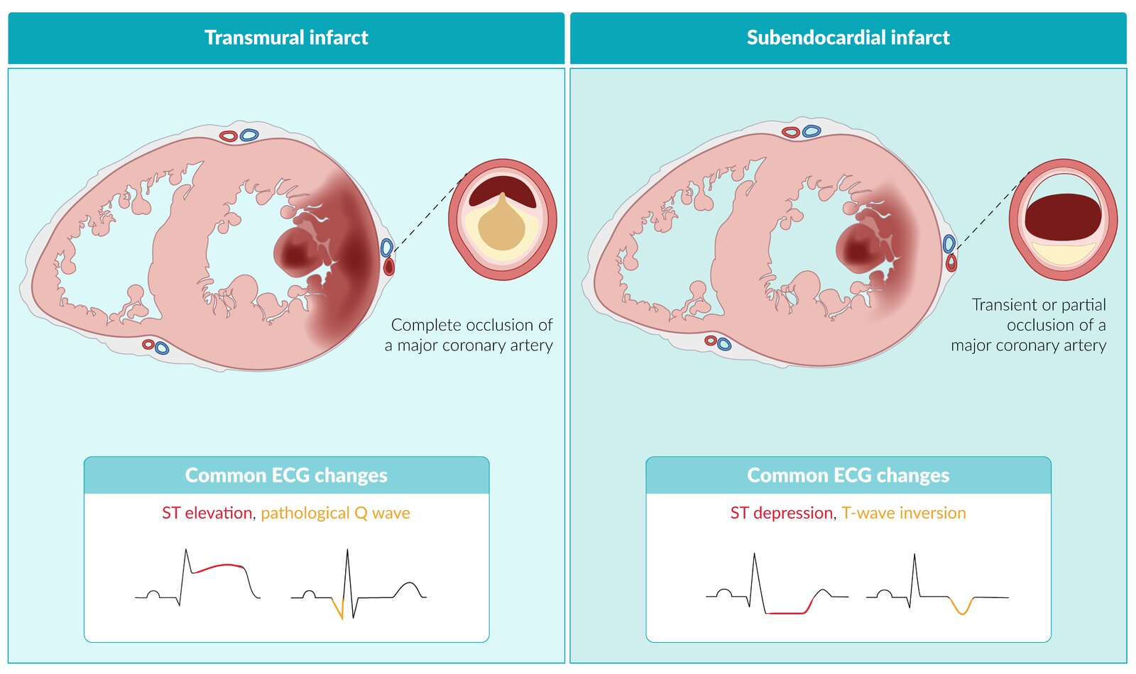Subendocardial and transmural myocardial infarction
