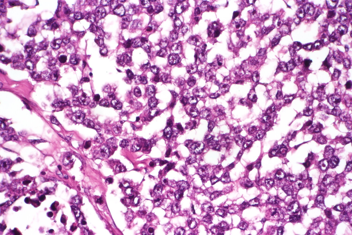 Dysgerminoma