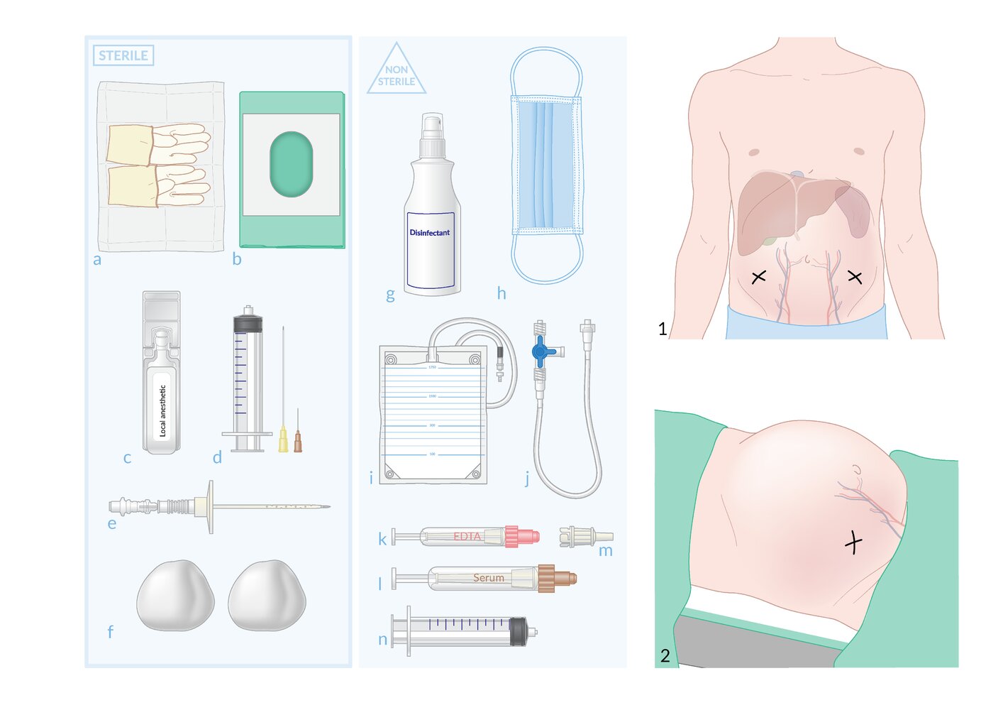 Paracentesis materials, insertion site, and patient positioning