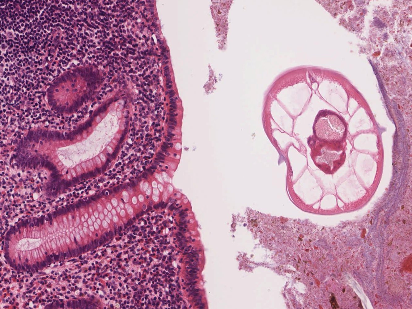 Vermiform appendix with enterobius vermicularis