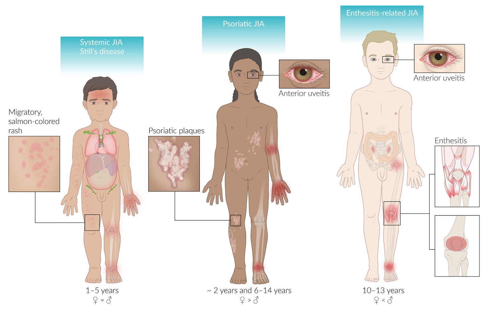 Systemic-, psoriatic-, and enthesitis-related juvenile idiopathic arthritis (JIA)