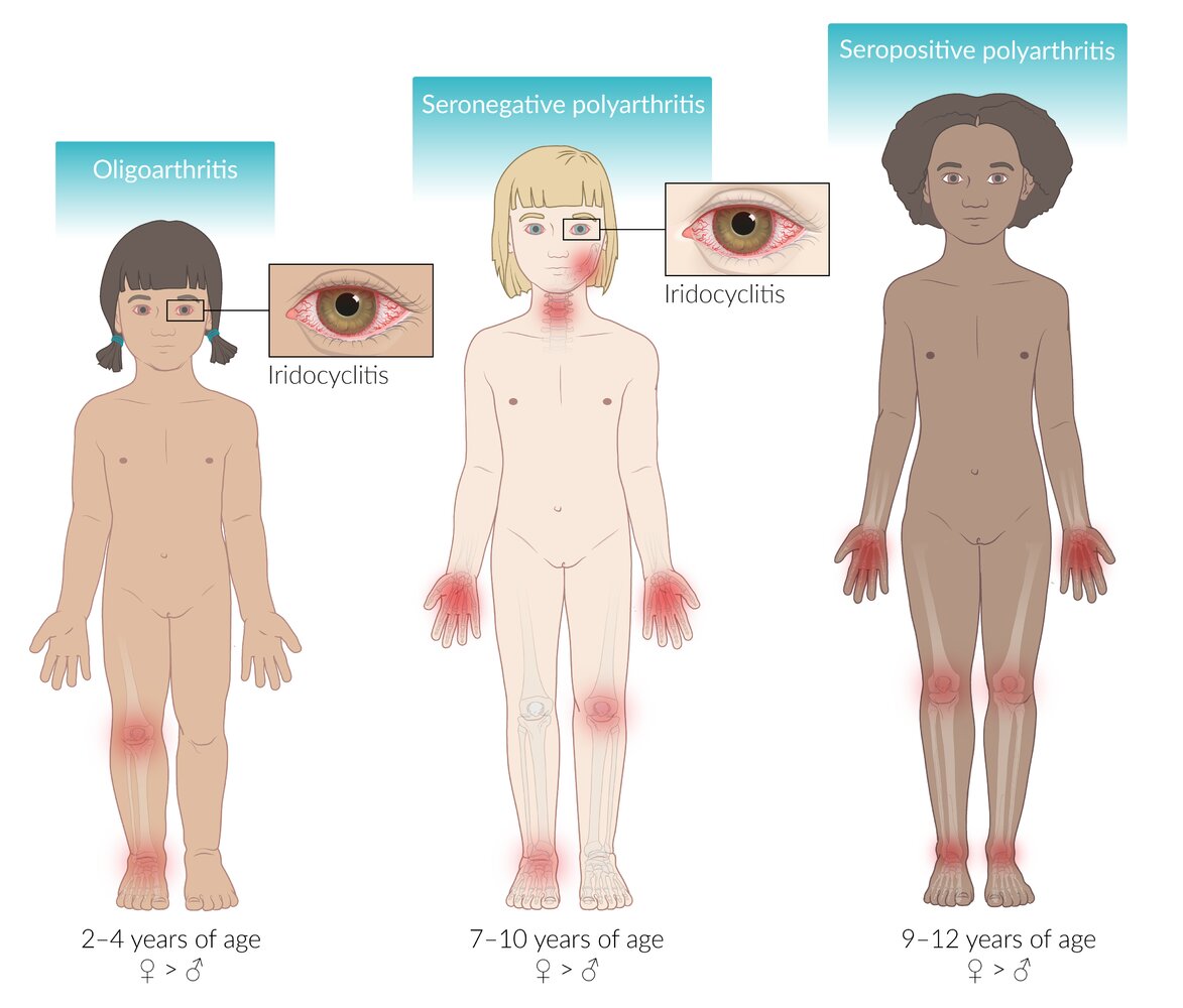 Pattern of joint involvement and iridocyclitis in juvenile idiopathic arthritis (JIA)