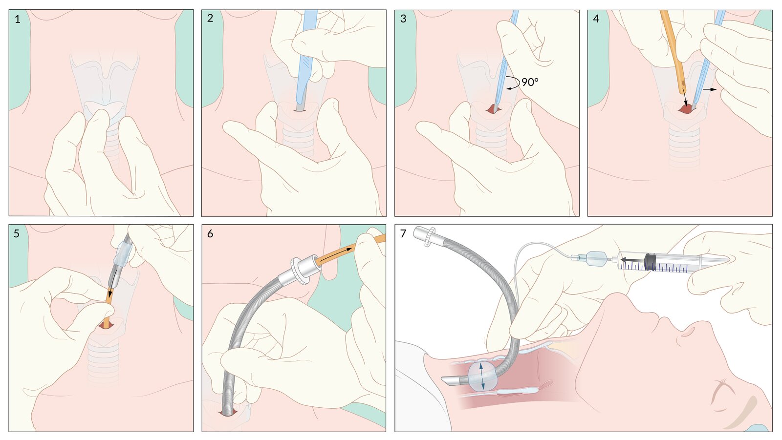 Surgical cricothyrotomy: stab-twist-bougie-tube technique