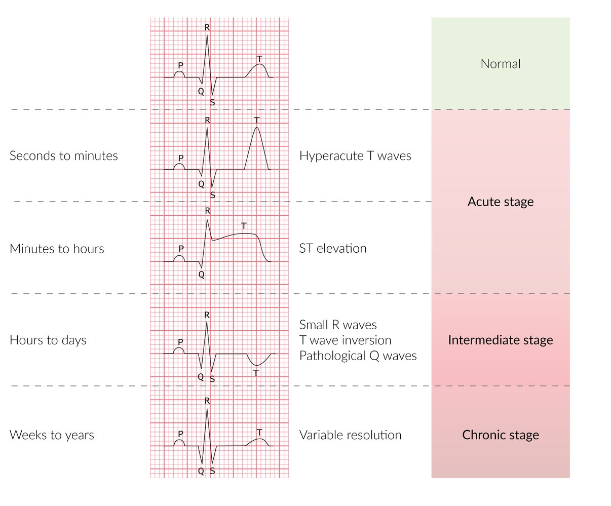 Timeline of ECG changes in STEMI