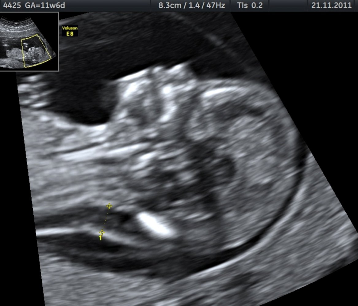 Increased nuchal translucency in Down syndrome