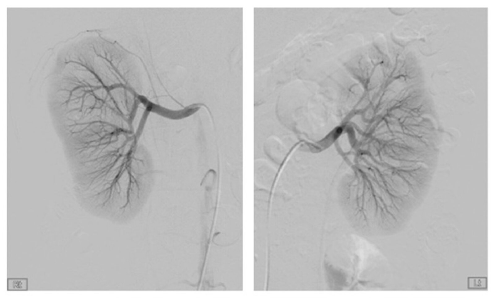 Renal artery microaneurysms