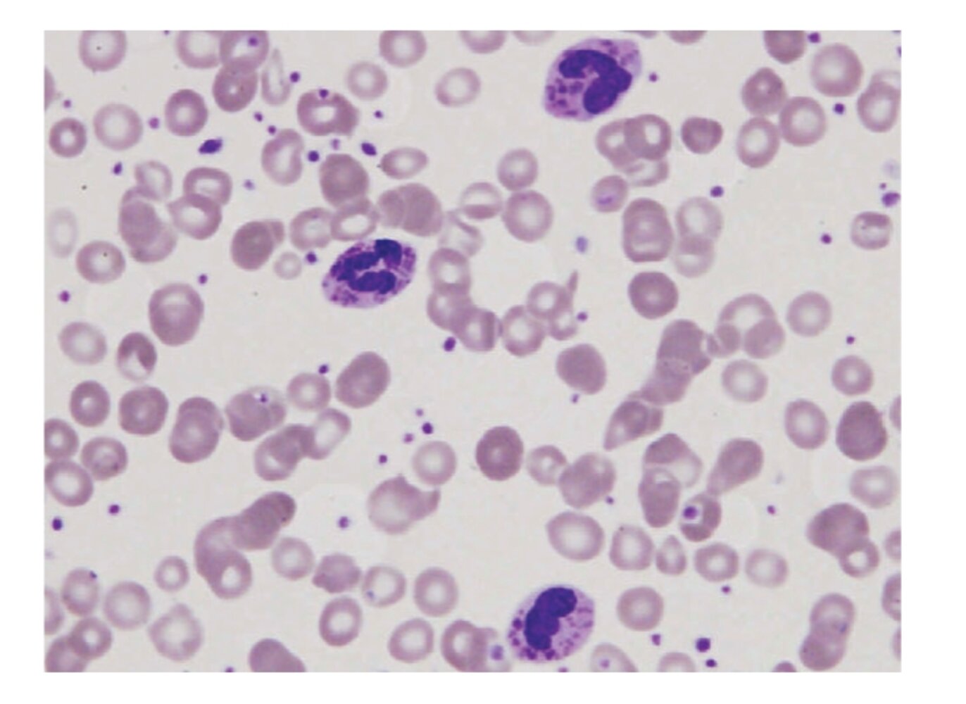 Chediak-Higashi syndrome