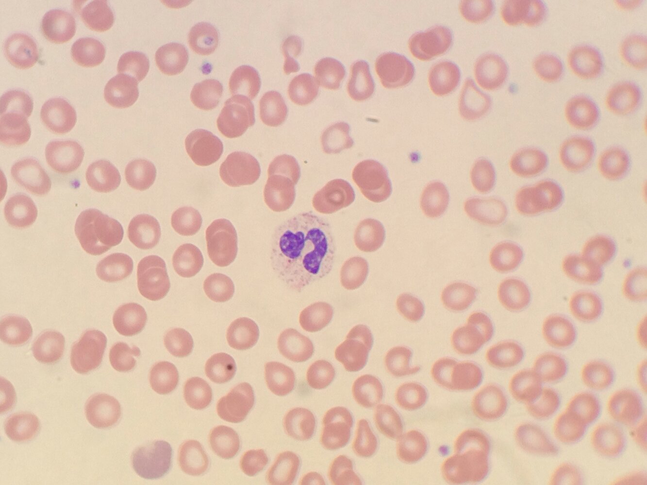 Pseudo-Pelger-Huet anomaly