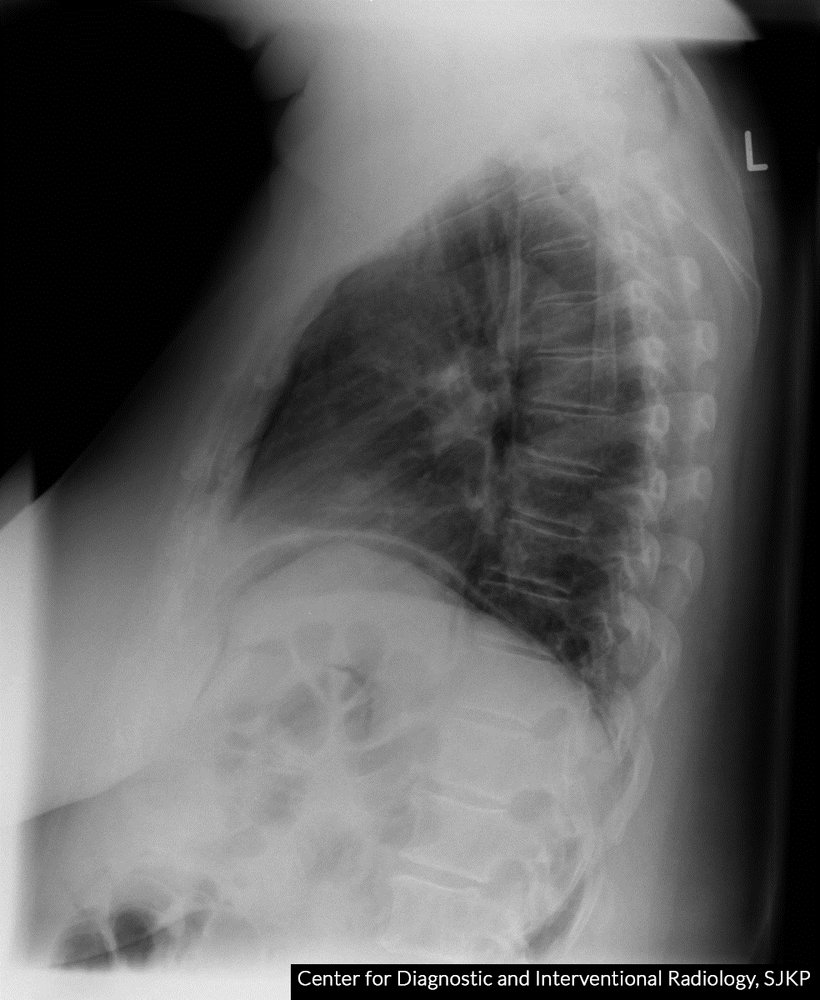 Pneumoperitoneum