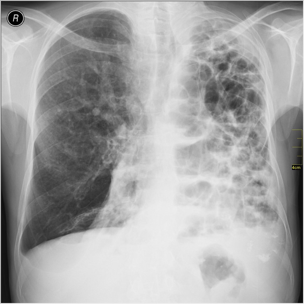 Bullous emphysema