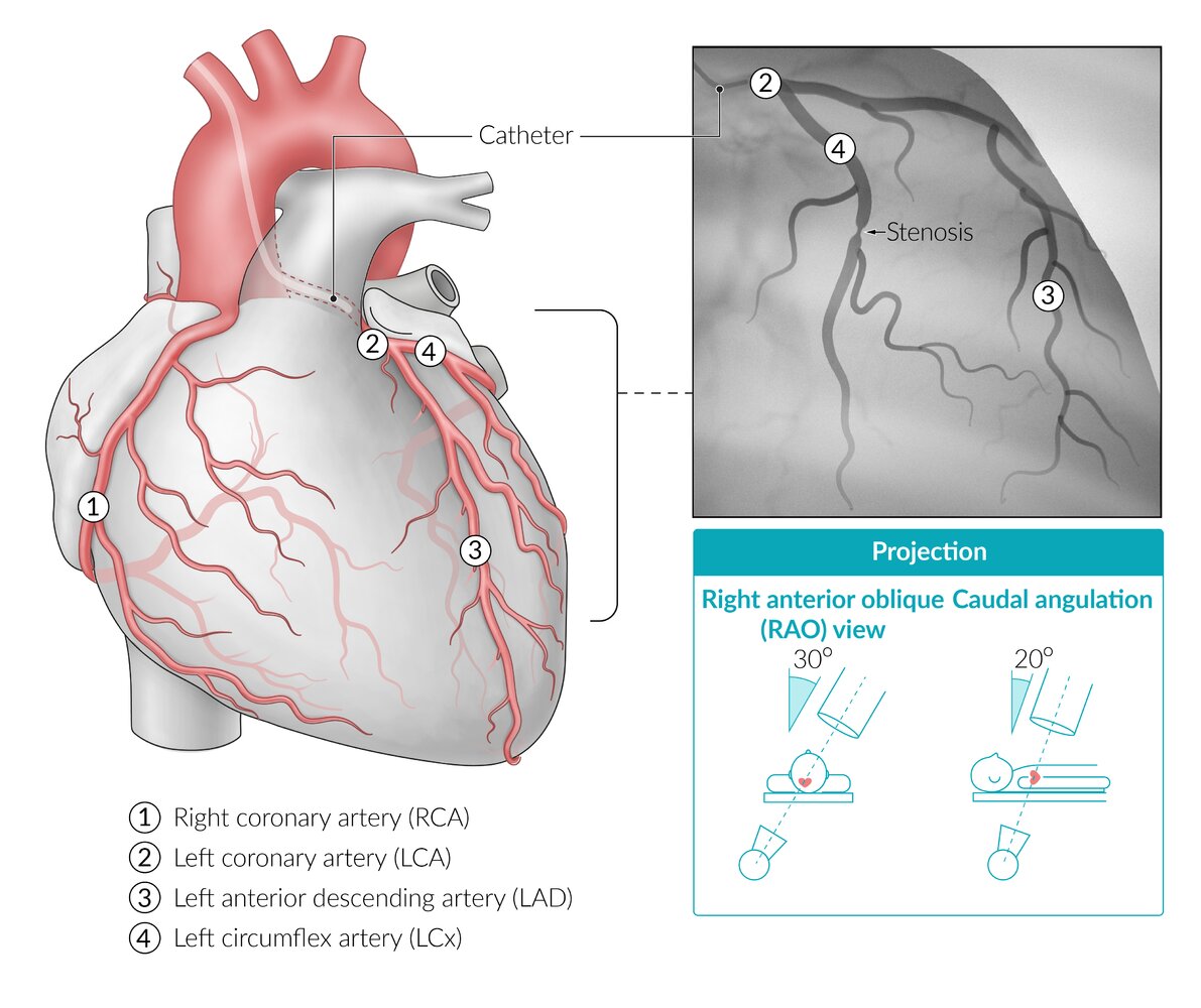Illustration of coronary angiography; left coronary artery (LCA)