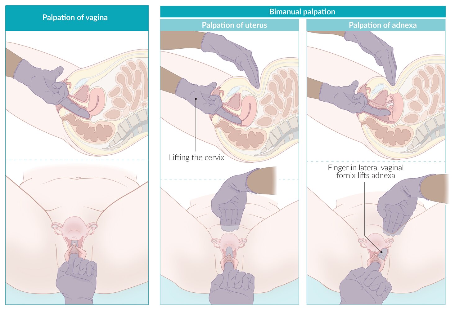 Bimanual pelvic examination