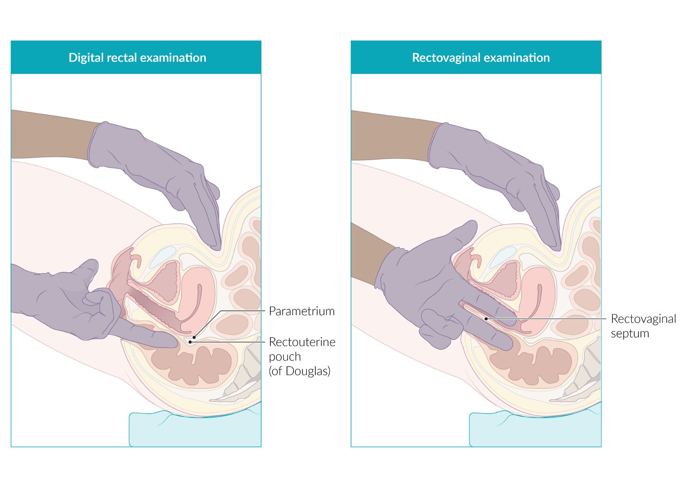Bimanual rectal and rectovaginal exams