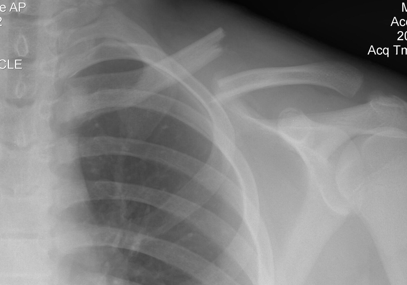 Clavicle fracture