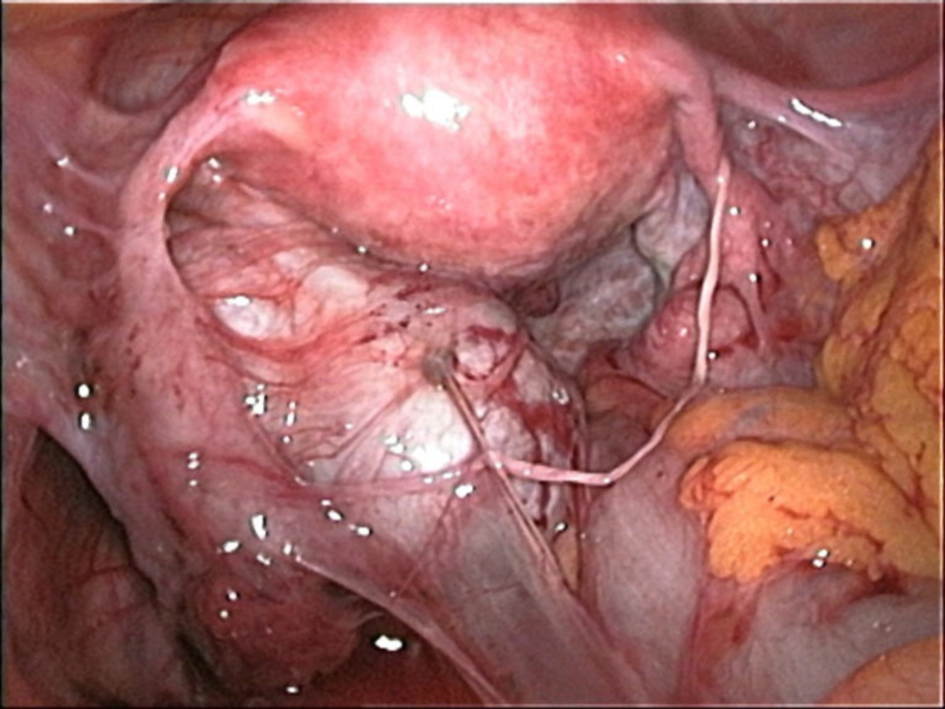 Endometriosis