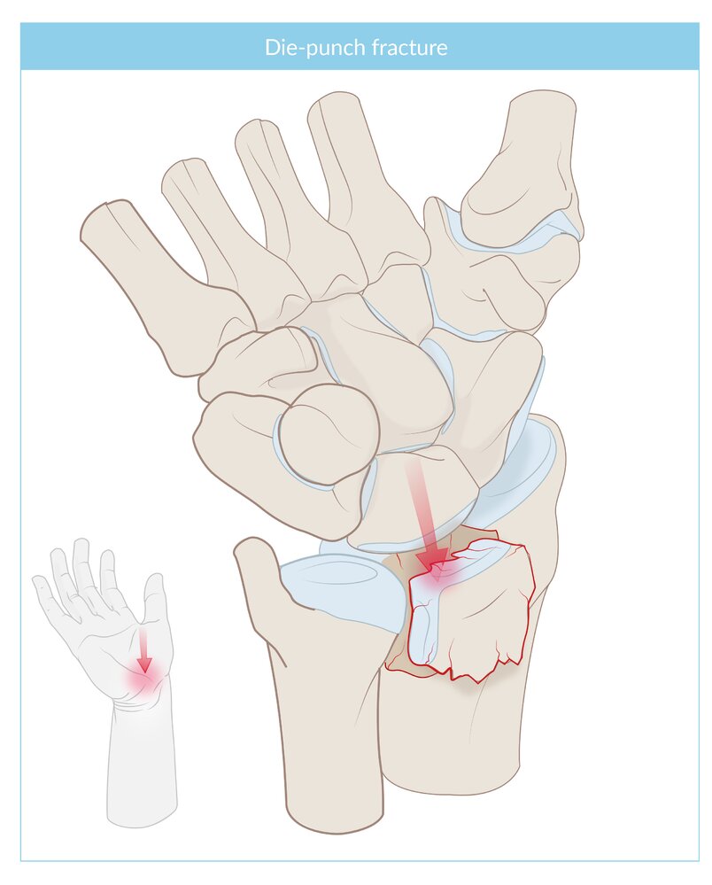 Die-punch fracture