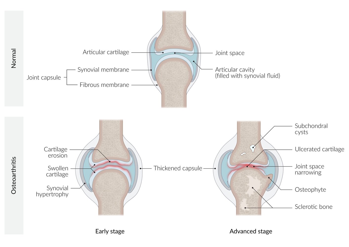 Pathophysiology of osteoarthritis