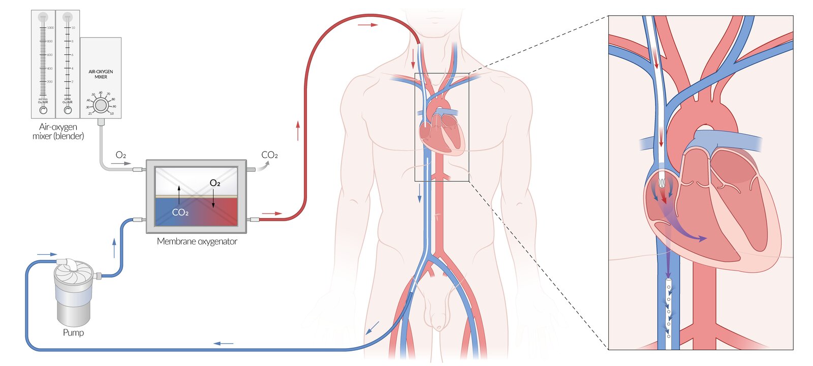 Venovenous extracorporeal membrane oxygenation