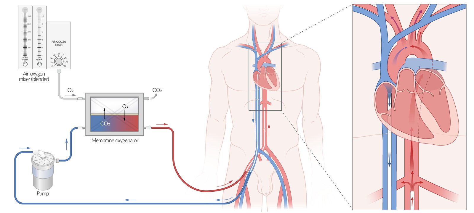 Venoarterial extracorporeal membrane oxygenation