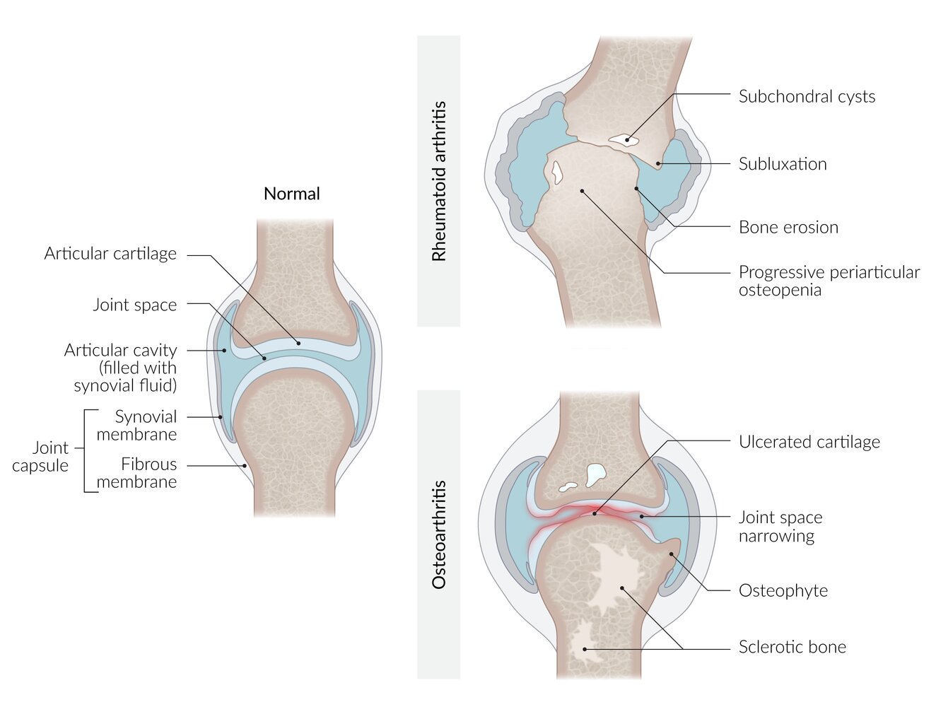 Comparison of morphological changes in osteoarthritis vs. rheumatoid arthritis
