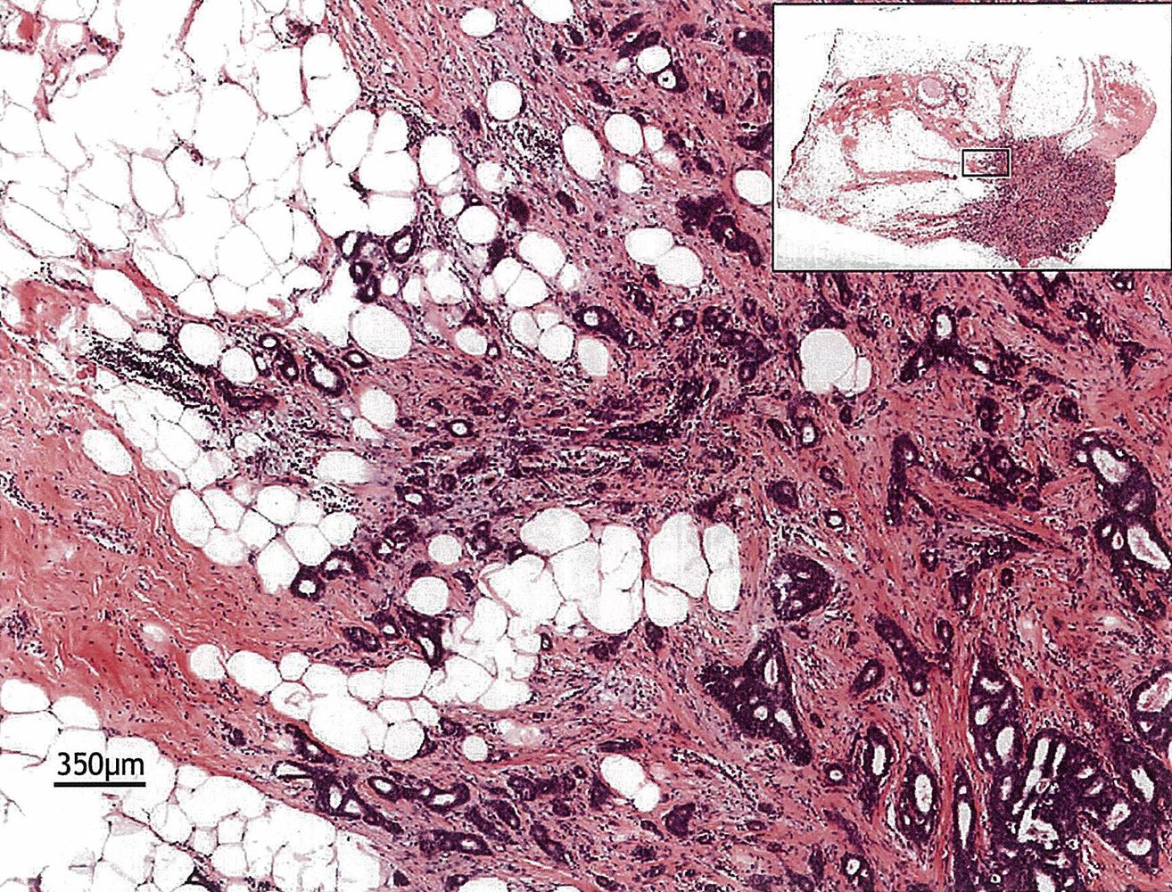 Invasive breast carcinoma of no special type (invasive ductal carcinoma) 2/3