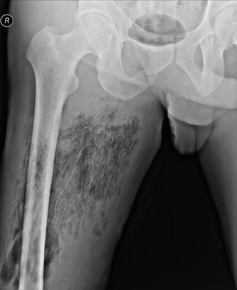 Gas gangrene