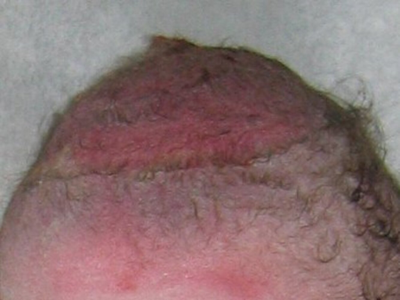 Scalp after vacuum extractor delivery