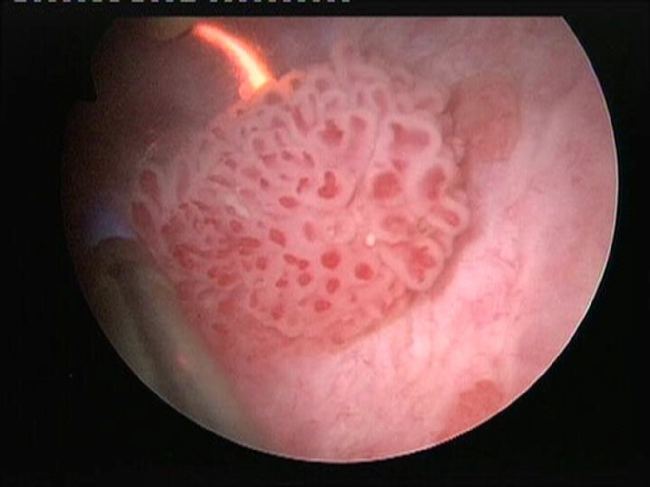 Urothelial carcinoma of the bladder