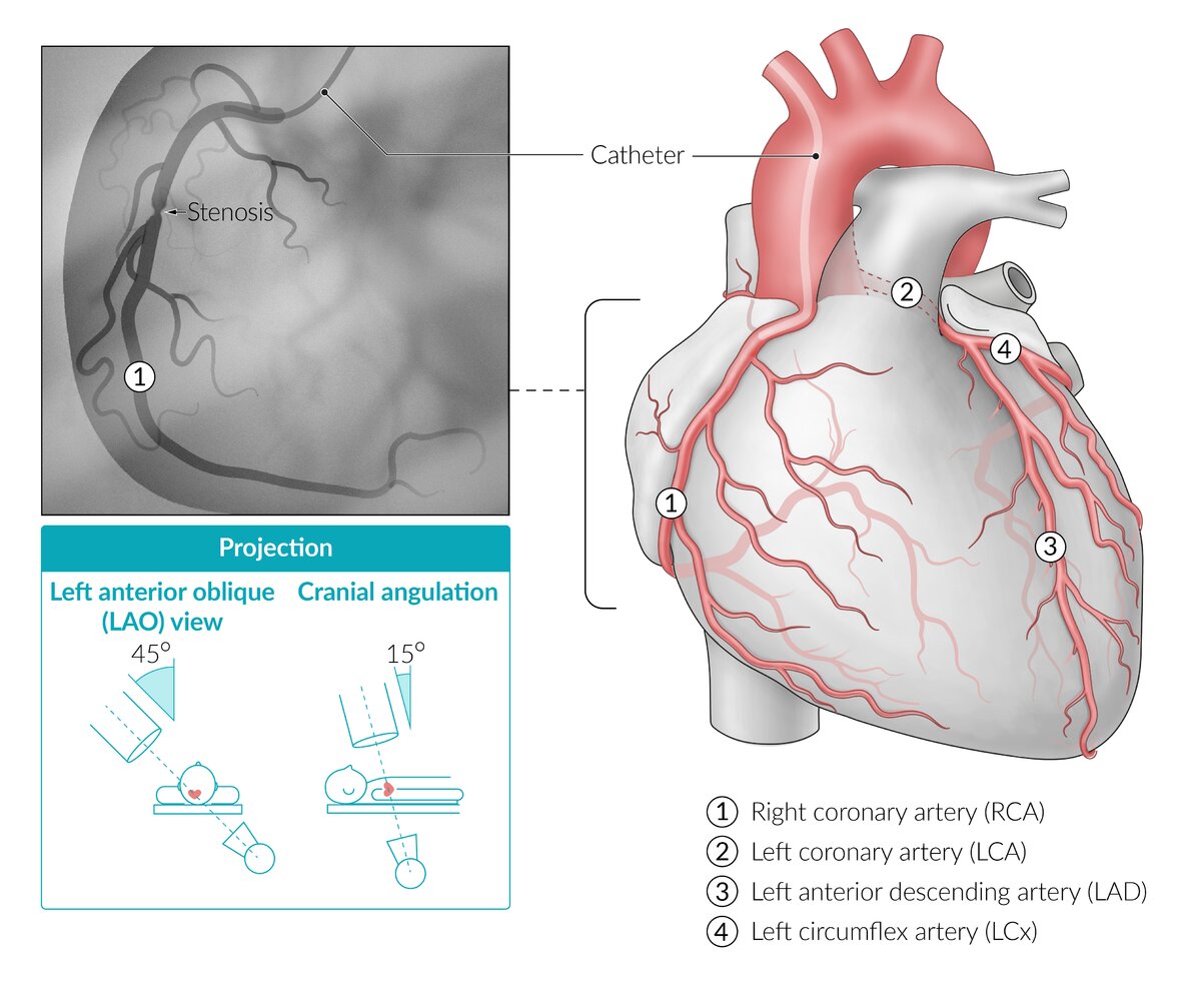 Illustration of coronary angiography; right coronary artery (RCA)