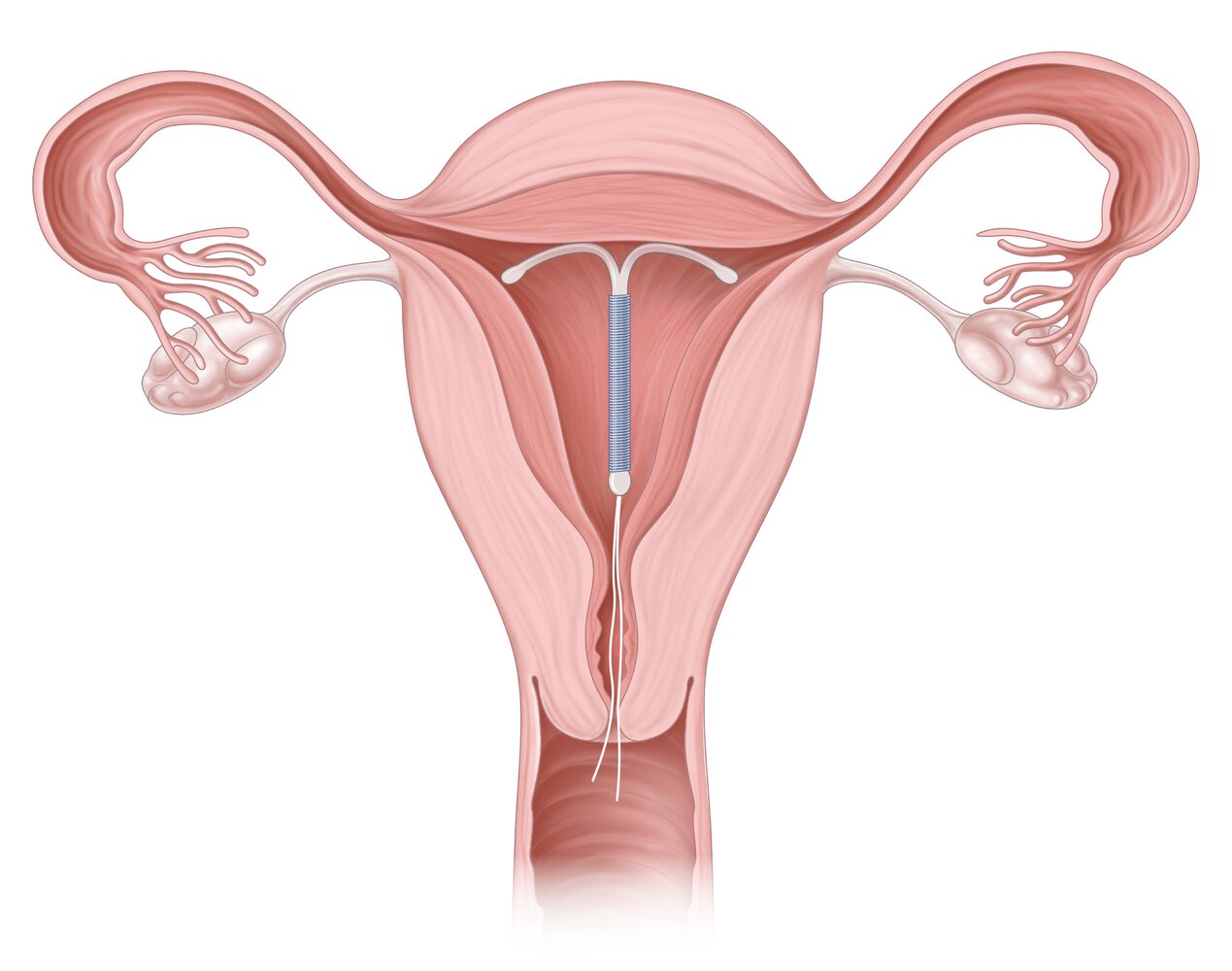 Intrauterine device in situ