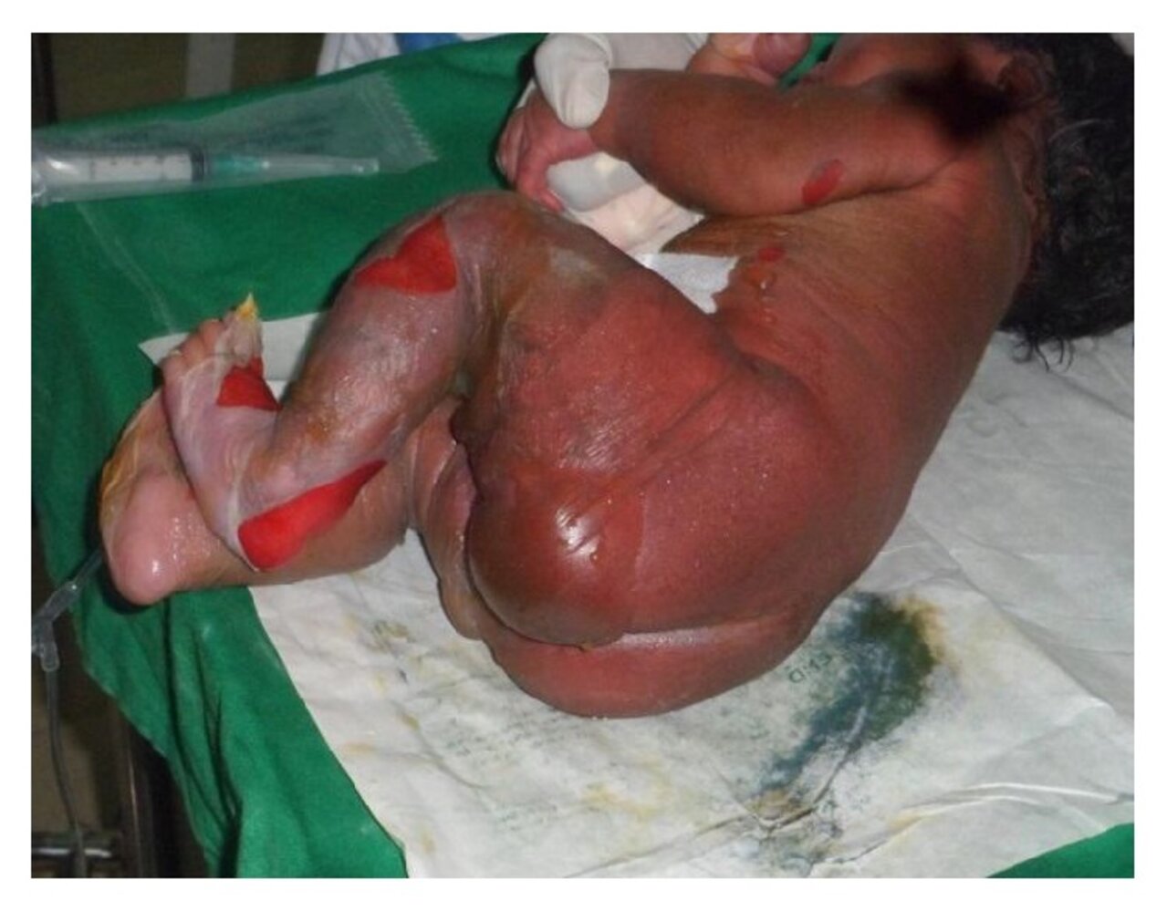 Staphylococcal scalded skin syndrome (SSSS)